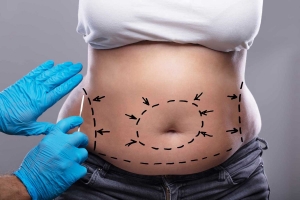 Liposuction Facts You Should Know Before Booking Your Procedure