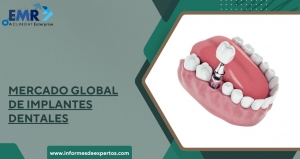 Perspectivas y Tendencias del Mercado Global de Implantes Dentales