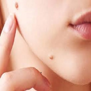 What Are Warts? Causes, Types, and Treatment Options