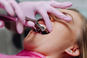 The Science Behind Tooth Extractions: How It’s Done Safely