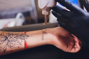 How Long Does Picosure Tattoo Removal Take to Show Results?