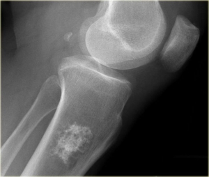 Chondrosarcoma Market to Surge with Innovative Targeted Therapies 