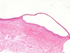 Bullous Pemphigoid Market to Grow Rapidly Owing to Rising Autoimmune Incidence