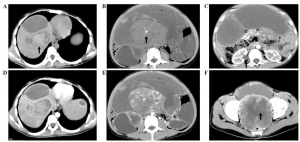 Bone Metastasis in Solid Tumors Market to Surge on Targeted Therapies 
