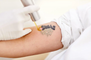 Laser Tattoo Removal Is the Future of Skin Renewal