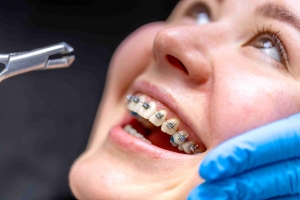 Revolution in Braces: What a Singapore Dentist Reveals About Self-Ligating Braces