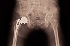 Total Hip Replacement in Lahore: What You Need to Know