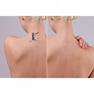The Science Behind Tattoo Removal: Explained Simply