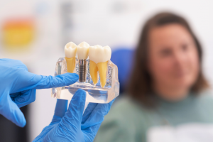 The Role of 3D Imaging and Technology in Dental Implants