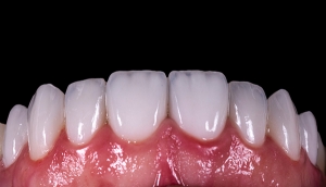 Dental Veneers for Chipped Teeth: How They Can Repair Your Smile