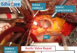 Aortic Valve Repair in India: A Life-Saving Alternative to Full Valve Replacement