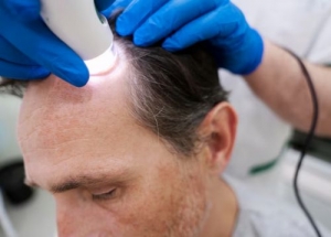 How Does a Hair Transplant Work? An In-Depth Guide