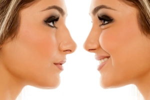 Rhinoplasty Surgery in Riyadh: Who Is an Ideal Candidate?
