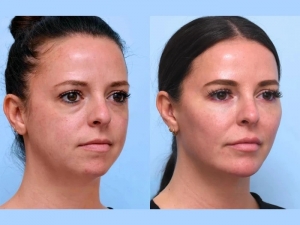 Thread Lift Aftercare: Essential Tips from the Best Aesthetic Clinic in Dubai
