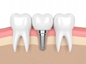 Life-Changing Results with Dental Implants in Dubai