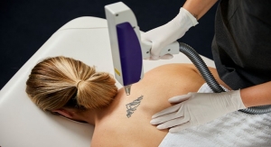 A Clean Slate Starts with Laser Tattoo Removal Power