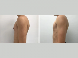 Gynecomastia in Teenagers: Is Surgery in Dubai the Right Solution?