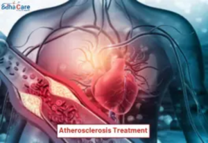Atherosclerosis Treatment in India: Advanced Care at Affordable Costs