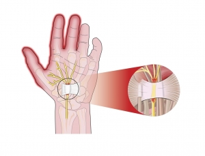 Carpal Tunnel Syndrome Treatment in Lahore: Expert Solutions for Hand Pain