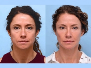 How Thread Lift Treatments in Dubai Are Revolutionizing Anti-Aging Solutions