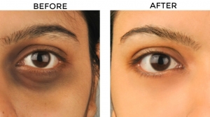 Best Dermatologists for Dark Circles in Islamabad