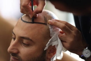 Get Fuller Hair with FUE Hair Transplant in Riyadh