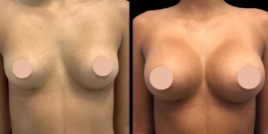 Types of Implants Used in Breast Augmentation Surgery in Dubai