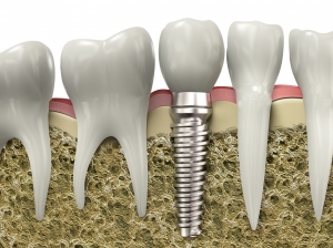 How Dental Implants in Dubai Solve Tooth Loss Permanently