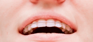 Why Are Retainers Important After Braces?