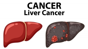 Living with Liver Cancer in Singapore: Treatment, Support & Hope