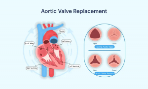 Aortic Valve Repair in India: Advanced Cardiac Care with High Success & Affordable Costs