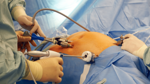 What You Need to Know Before Obesity Surgery