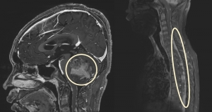 Pediatric Brain Tumors Market Trends by Targeted Therapy Advances