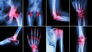 Everything You Should Know About Joint Supplements