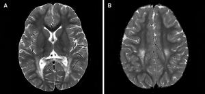 Krabbe Disease Market Surges by Gene Therapy Advancements