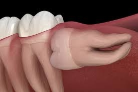 Cost of Wisdom Tooth Extraction: What to Know