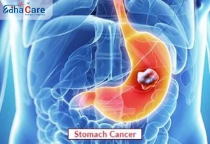 Comprehensive Guide to Stomach Cancer Treatment in India: Procedures, Success Rate & Cost