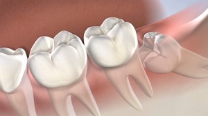 How to Prepare for Your Wisdom Tooth Removal: Tips from Pleasant Dental
