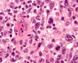 ALCL Treatment Market Trends Driven by Targeted Therapies