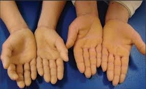 Palmoplantar Keratoderma Market is in trends  Rising Prevalence