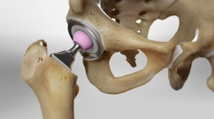 When to See an Orthopedic Surgeon Hip Specialist: Signs, Treatment, and Recovery
