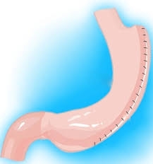 How Gastric Plication Works