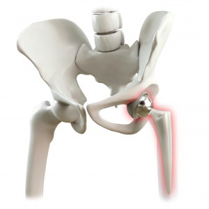 Understanding Hip Replacement Surgery: A Comprehensive Guide