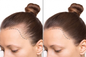 Best Treatments for Hair Loss: A Comprehensive Guide