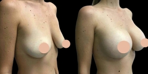 Inside the Operating Room: Best Breast Augmentation Surgeon in Dubai Shares Insights