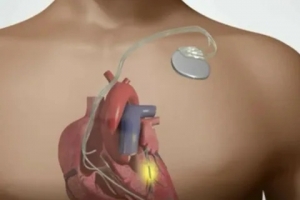Cardiac Pacemaker Market to Soar Due to Rising Arrhythmia Cases