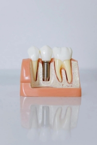 Reclaim Your Smile Today! Why Same-Day Crowns Are a Game Changer