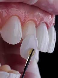 Does Dental Bonding Hurt?