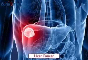 Liver Cancer in India: A Growing Focus of Global Oncology