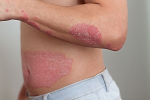 Can Stress in a Busy City Like Dubai Trigger Skin Conditions?
